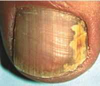 На фото типичное грибковое поражение ногтей. Затронута вся длина, лечение как при тотальном онихомикозе