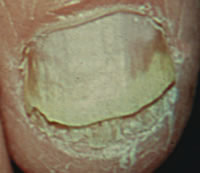 Ногтевой грибок на руках. Фото дистальной формы онихомикоза