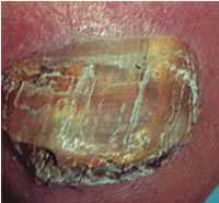 Длительно существующее грибковое заболевание ногтей привело к дистрофии. Тотально-дистрофическая разновидность онихомикоза