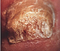 Одна из самых тяжелых форм грибковой инфекции с выраженным утолщением ногтя. Так называемый гипертрофический онихомикоз