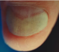 Изменение цвета ногтя при грибковом заболевании. Грибок находится под ногтевой пластинкой