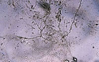 Ногтевой грибок под микроскопом